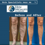 Superficial And Deep Vein Procedures, Vein Specialists of the Carolinas Today is TransformationTuesday!