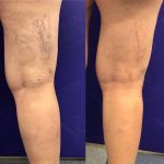 Today is Transformation Tuesday! Check out this amazing before and after photo., Vein Specialists of the Carolinas It is Transformation Tuesday - Vein Specialists of the Carolinas