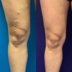 Today is Transformation Tuesday! Check out this amazing before and after photo., Vein Specialists of the Carolinas Today is #TransformationTuesday!