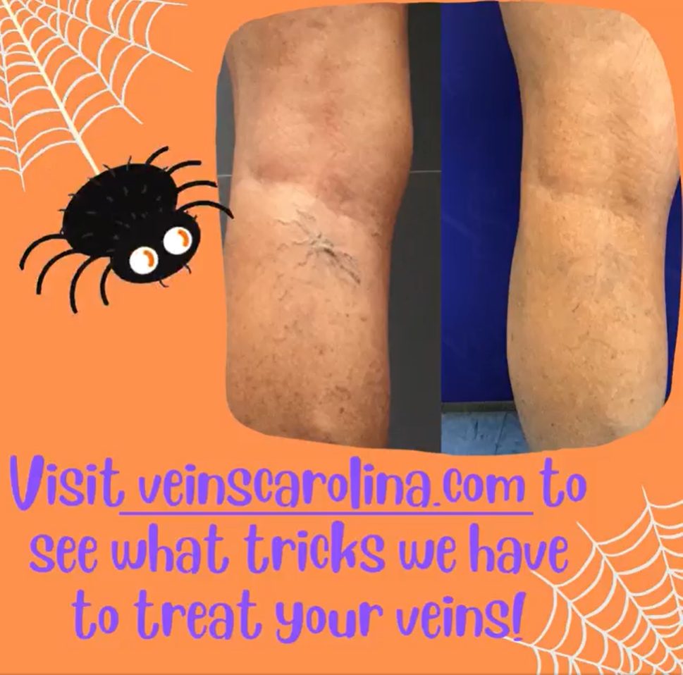 spooky_spider_veins