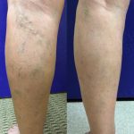 Happy May Everyone!, Vein Specialists of the Carolinas Sclerotherapy Is A Less-Invasive Way To Get Rid of Spider Veins
