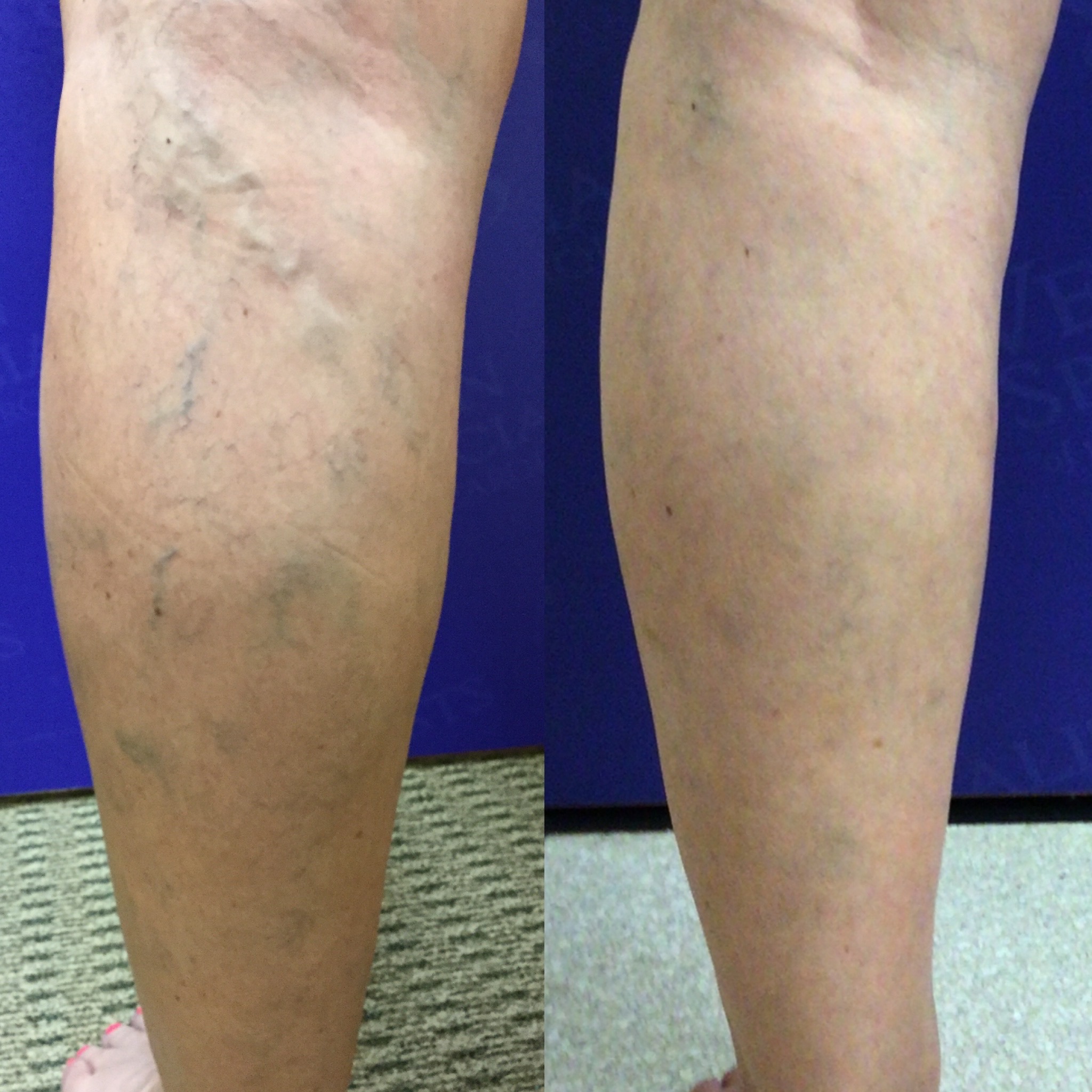 Sclerotherapy Is A Less-Invasive Way To Get Rid of Spider Veins