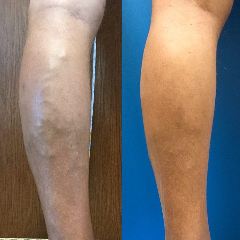 Why Weight Loss is Good for Your Veins