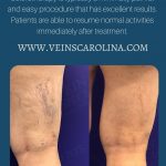 Sclerotherapy Treatment – Before and After for Women and Men, Vein Specialists of the Carolinas jan 2022 sclerotherapy special