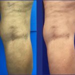 Today Is Testimonial Thursday!, Vein Specialists of the Carolinas sclero before and after 8