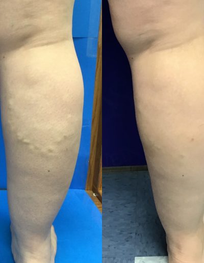 Before and After Vein Treatment Photos, Vein Specialists of the Carolinas