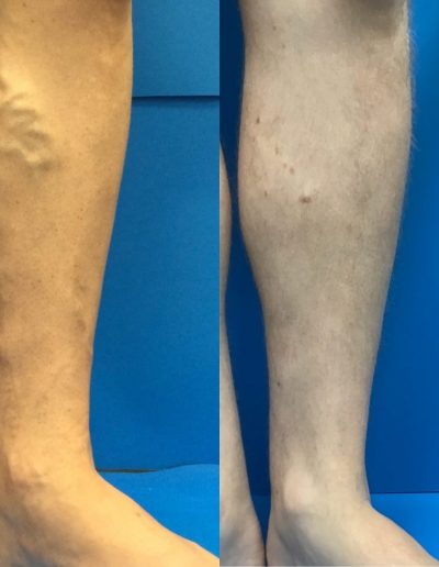 Before and After Vein Treatment Photos, Vein Specialists of the Carolinas