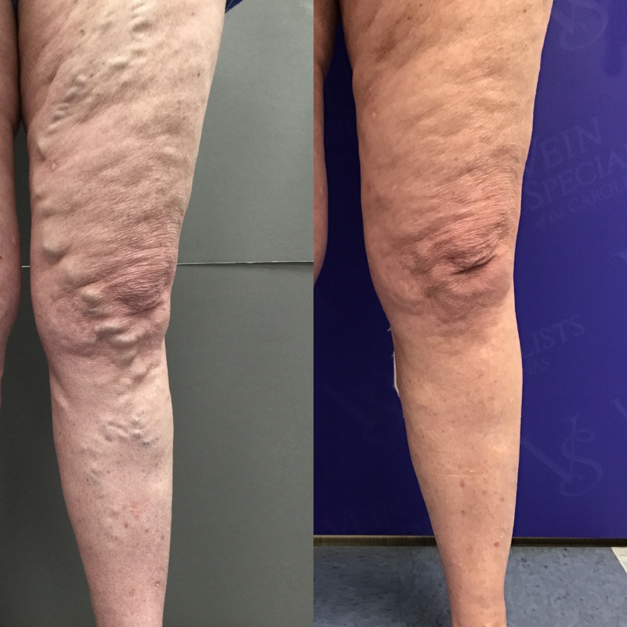Can the Benefits of Vein Care Improve Your Life?