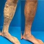 Fall Vein Treatment Is the Perfect Time!, Vein Specialists of the Carolinas varicose veins and cold weather