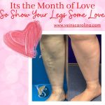 🎃🕷️✨ FREAKY FRIDAY ✨🦇🎃 Are Your Veins Scary?, Vein Specialists of the Carolinas Show Your Legs Some Love