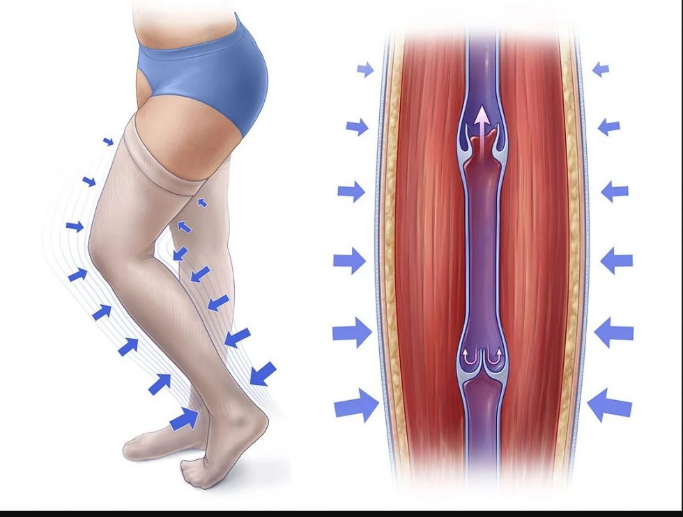 The Effects and Benefits of Medical Compression Vein Specialists of