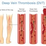 Decreased Activity Can Increase The Risk Of Blood Clots, Vein Specialists of the Carolinas deep vein awareness