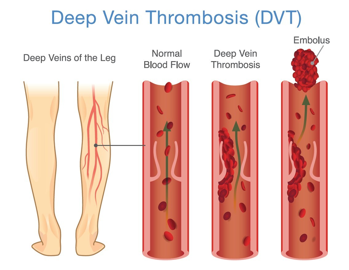 What Can Cause The Blood To Clot? DVT Awareness