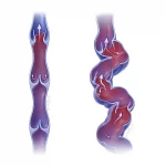 We Provide the Highest Quality And Most Attractive Compression Garments Made, Vein Specialists of the Carolinas What Are Varicose Veins?