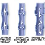 Venous Reflux and blood flow