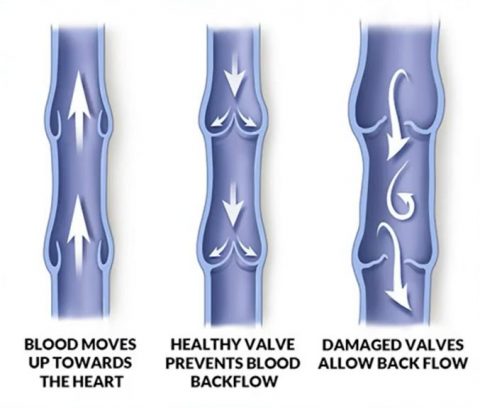 Venous Ultrasound Archives - Vein Specialists of the Carolinas