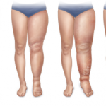 what is lymphedema