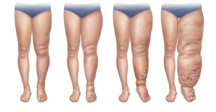 What Is Lymphedema?