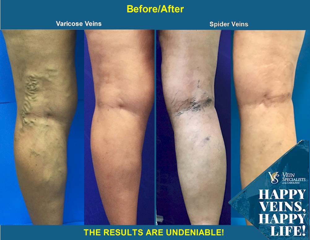 Why Is Vein Health Important? - Vein Specialists of the Carolinas