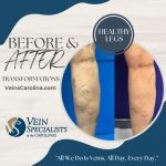 10% Off Cosmetic Sclerotherapy for Spider Veins – Call for An Appointment!, Vein Specialists of the Carolinas Before and After Leg Transformations