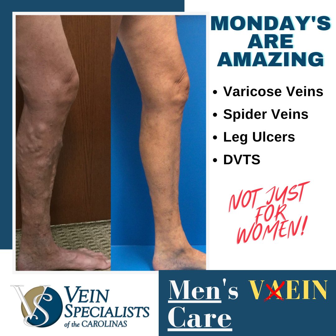 Men’s Vein Care – Mondays are Amazing!