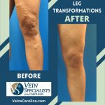 LEG TRANSFORMATIONS