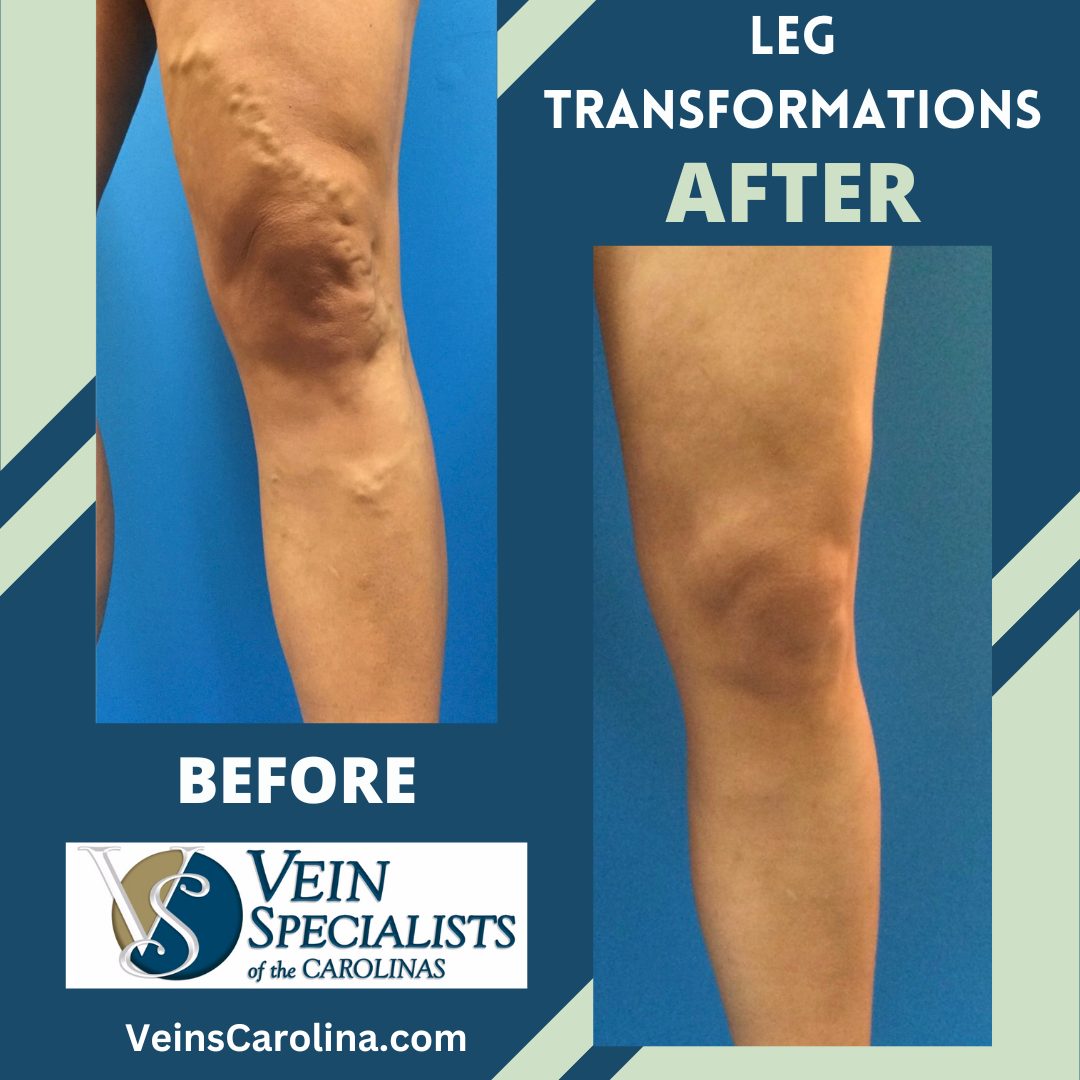 LEG TRANSFORMATIONS – Before and After Varicose Veins Treatment