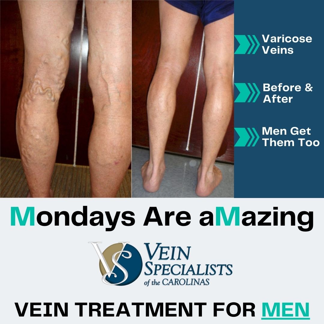 Make Your Monday Amazing – Men’s Vein Treatment