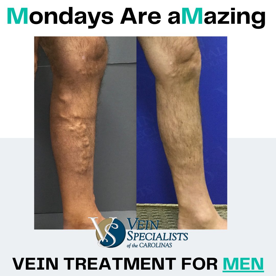 Mondays Are aMazing - Vein Treatment for Men
