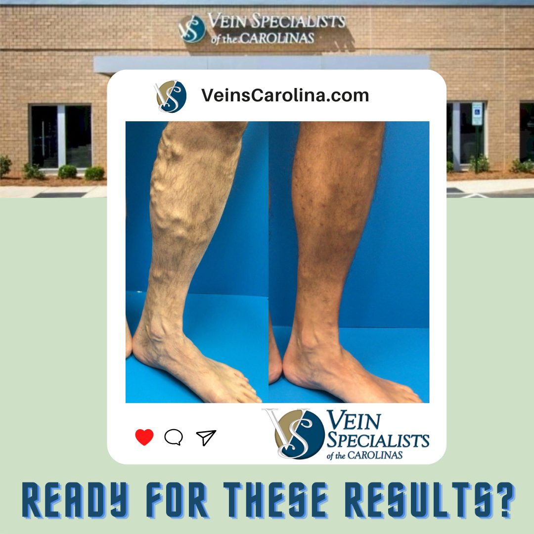 Vein Care for Women AND MEN!