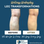Wellness Wednesday - Leg Transformations
