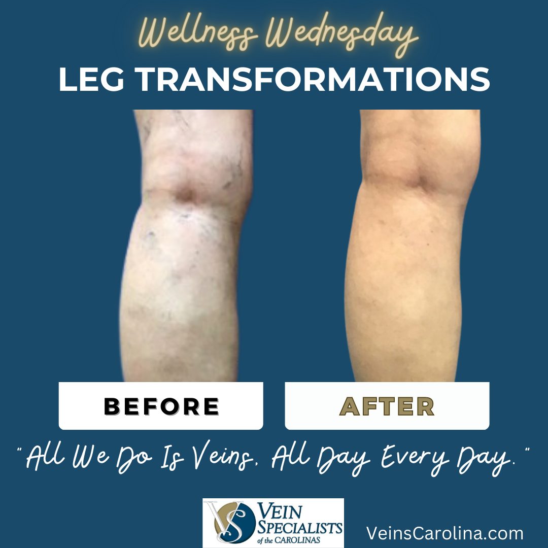Wellness Wednesday - Leg Transformations
