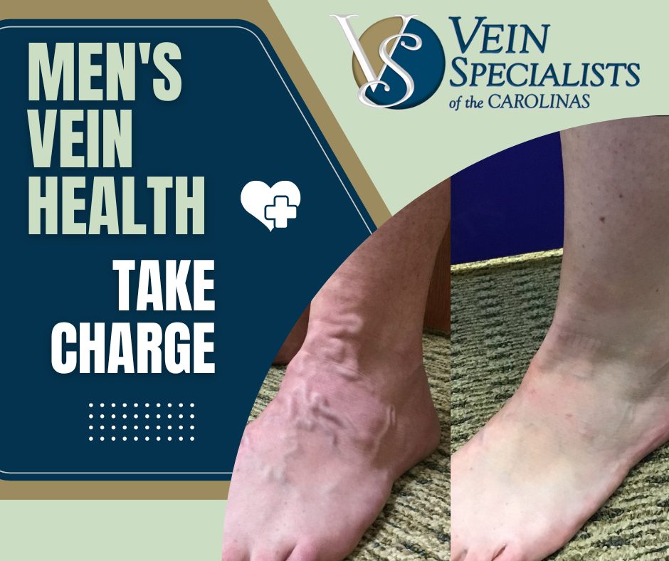 Taking Charge of Your Health: Men and Varicose Veins