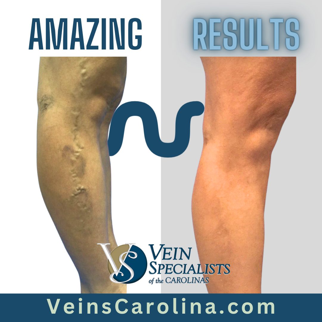 Amazing Results! Leg Transformations by VSC.