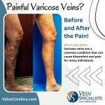 Dealing with the Discomfort of Painful Varicose Veins