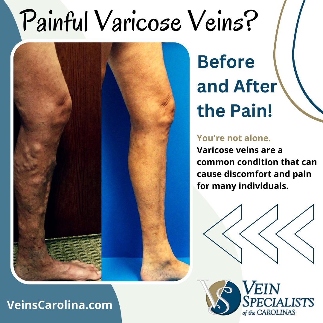 Painful Varicose Veinsspider Veins Varices On A Severely Affected