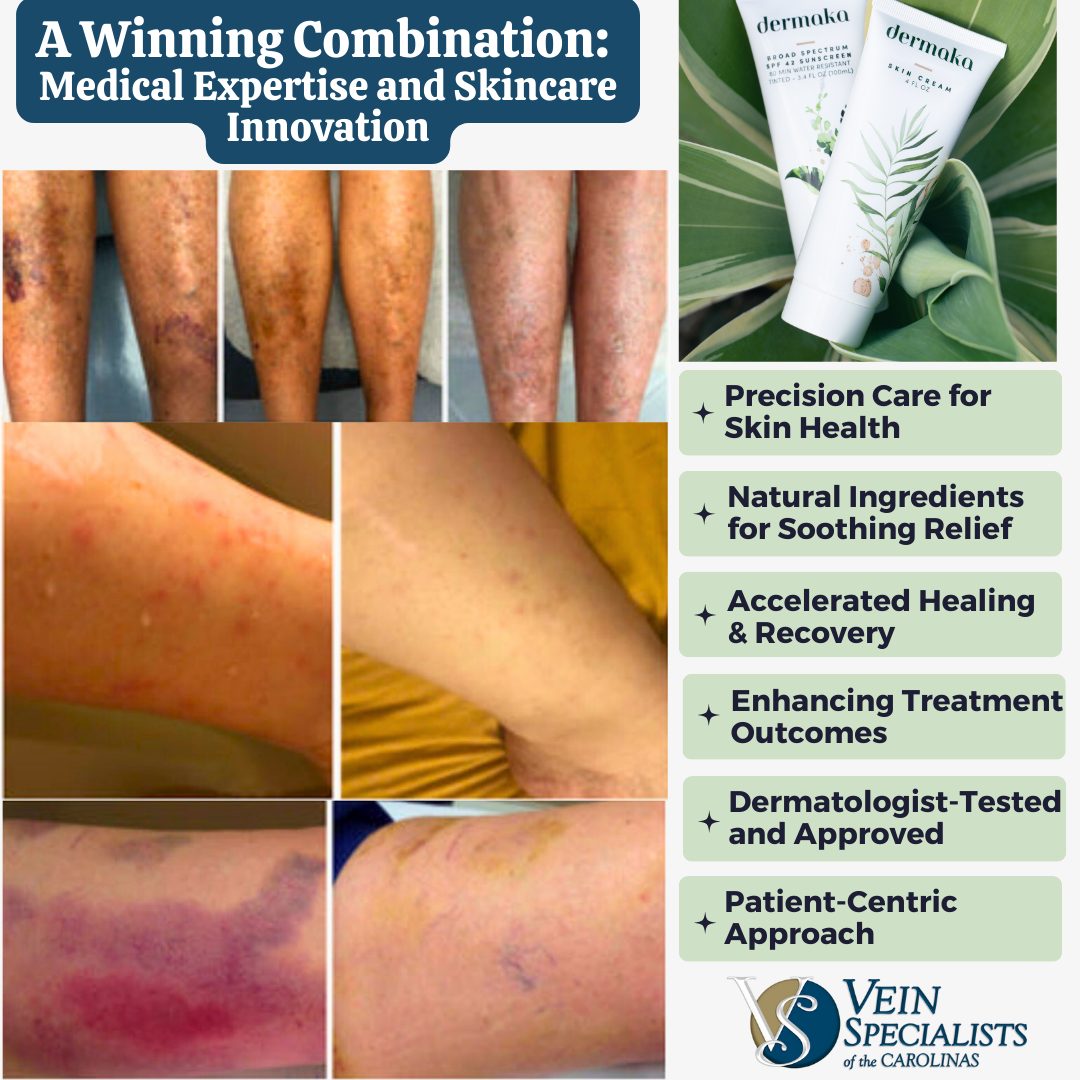 Dermaka Skincare – A Game-Changer in the field of Vein Treatments.