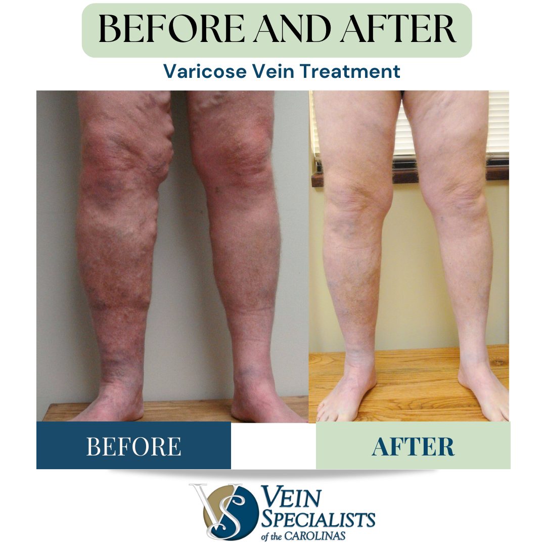 Comprehensive Vein Care: From Consultation to Recovery