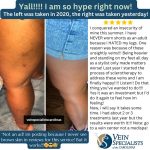 Happy Friday! Cosmetic Sclerotherapy Special Ends This Month., Vein Specialists of the Carolinas Embracing Confidence and Conquering Insecurities - Patient Testimonial