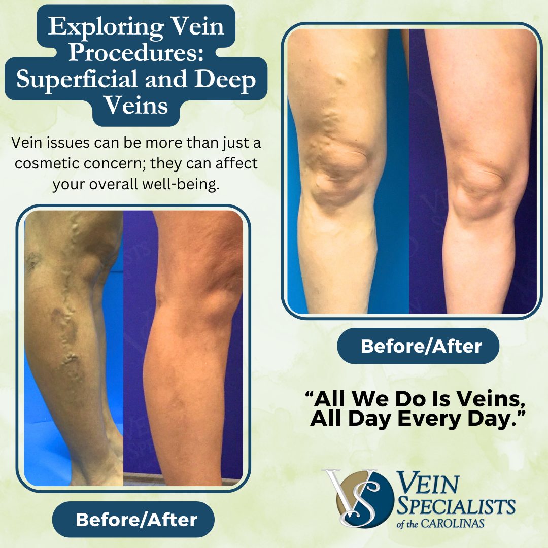 Exploring Vein Procedures: Superficial and Deep Veins