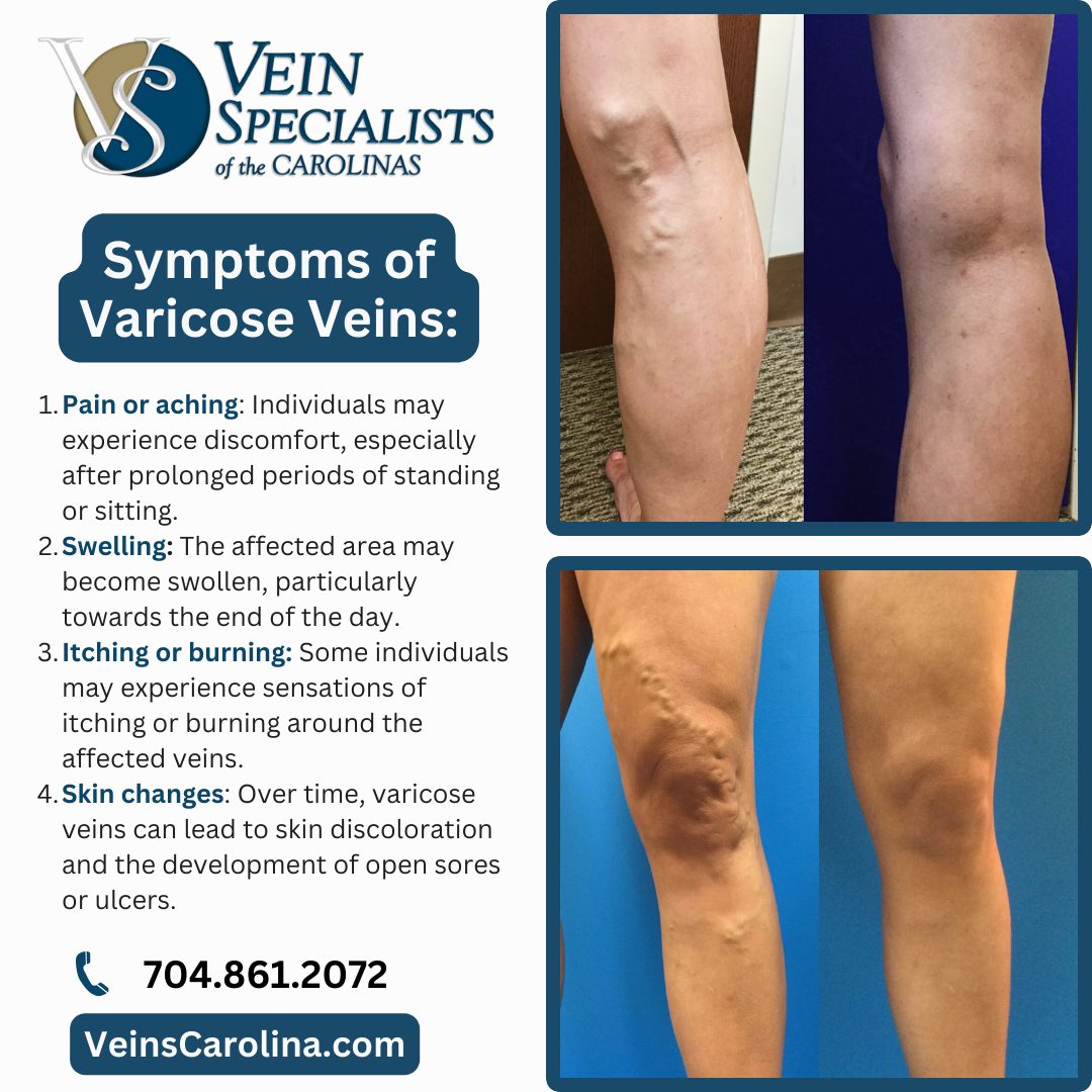 Varicose Veins Symptoms & Treatment