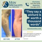 3 Reasons to Choose VSC for Varicose Vein Treatment