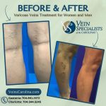 Understanding Varicose Veins: Symptoms, Treatments, and the Liberating Results