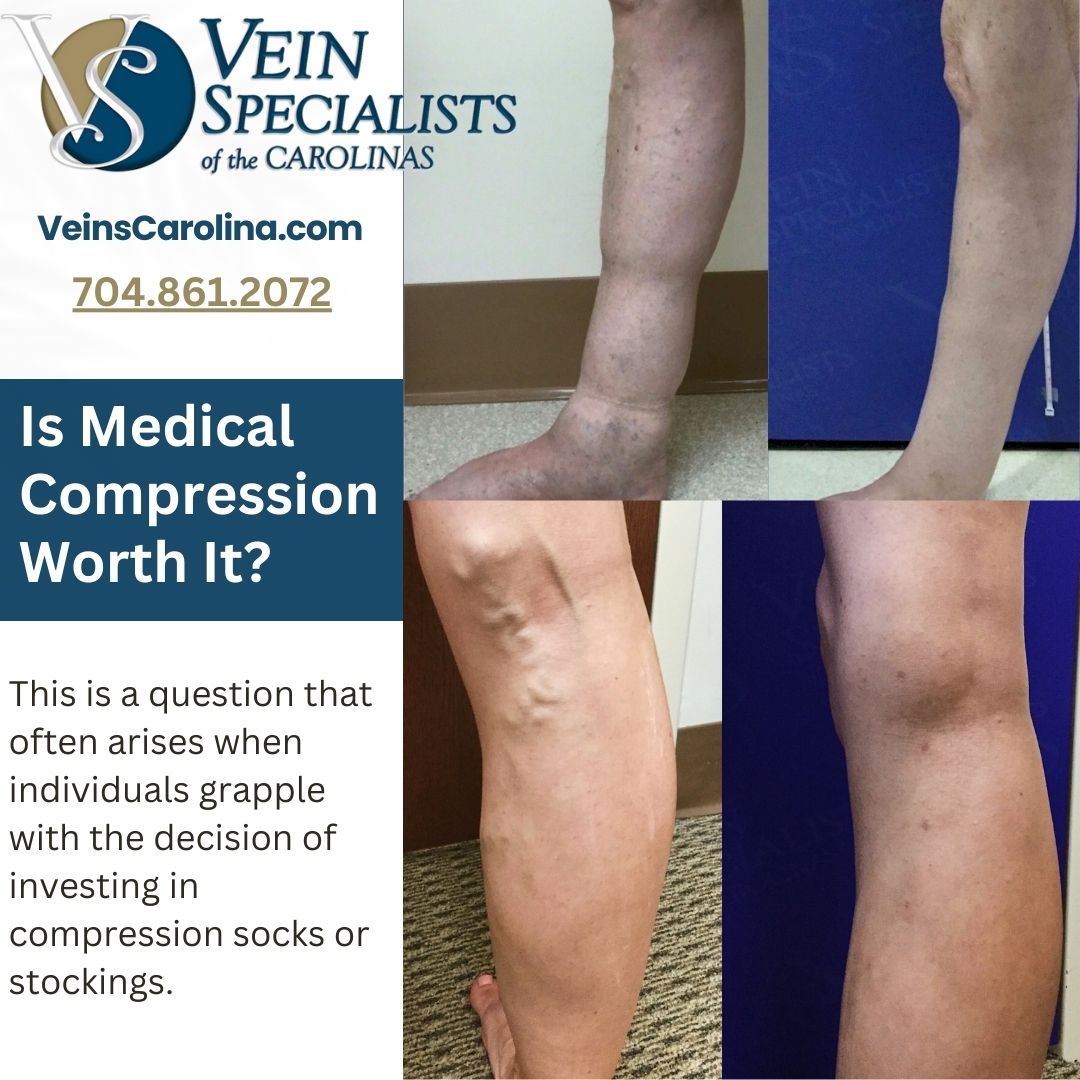 The Benefits of Medical-Grade Compression in Treating Chronic Venous Insufficiency