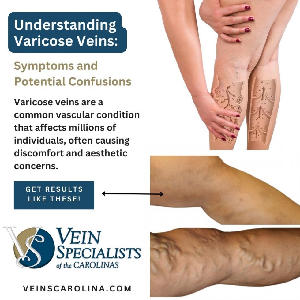 Understanding Varicose Veins Symptoms And Potential Confusions Vein Specialists Of The Carolinas