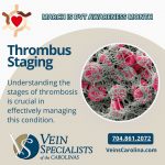 Don’t Let This Vein Disorder Ruin Your Summer Travel, Vein Specialists of the Carolinas Thrombus Staging: A Closer Look