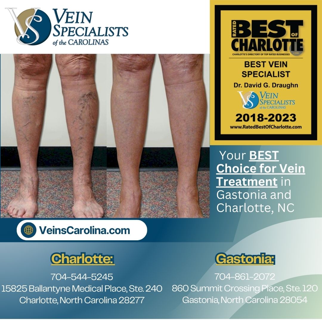 Vein Specialists of the Carolinas: Your BEST Choice for Vein Treatment in Gastonia and Charlotte, NC