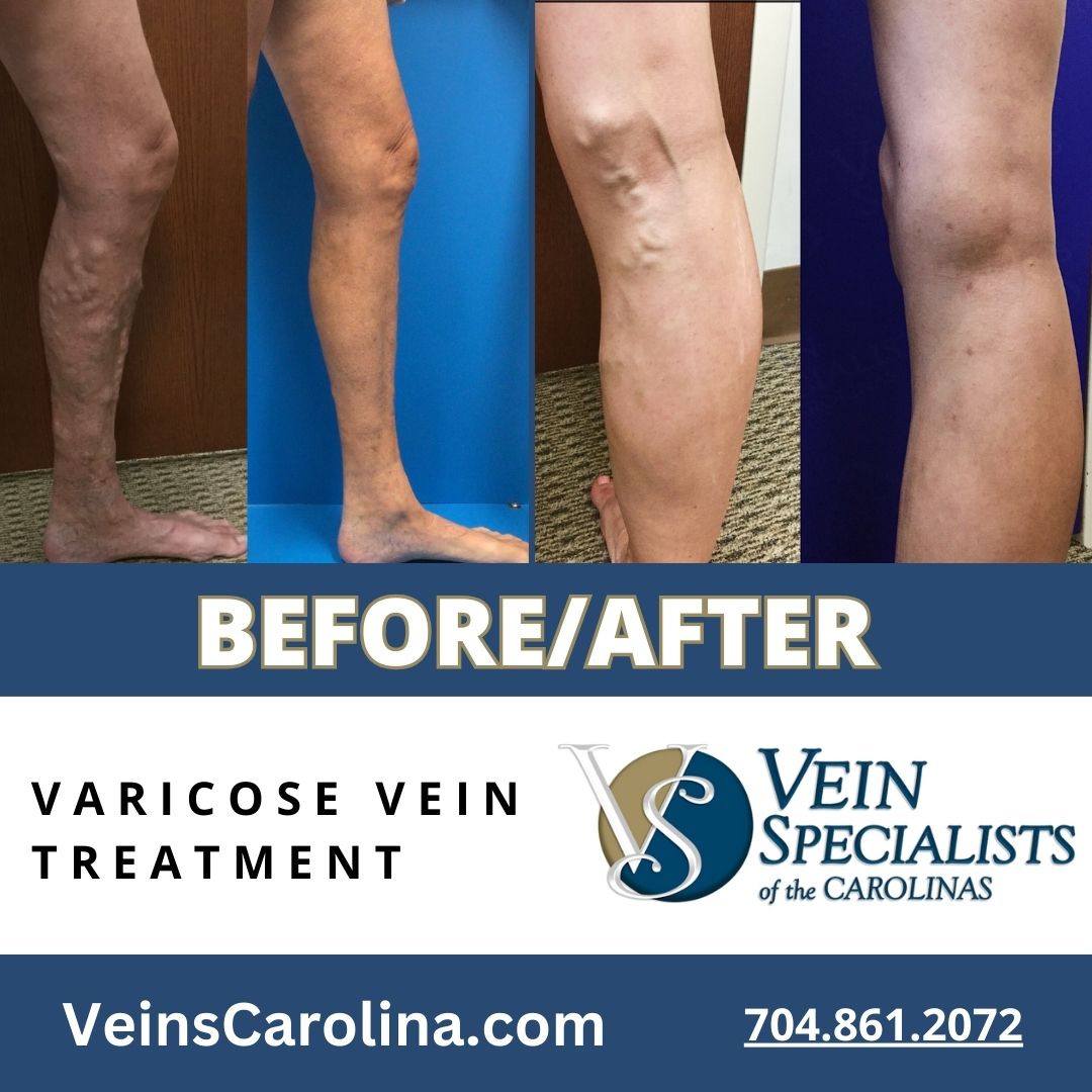 Reclaiming Confidence: Before and After Vein Treatment
