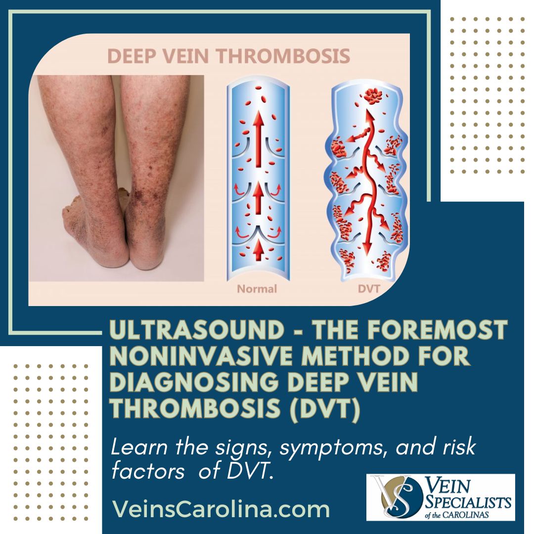 Ultrasound - The Foremost Noninvasive Method for Diagnosing Deep Vein Thrombosis (DVT)