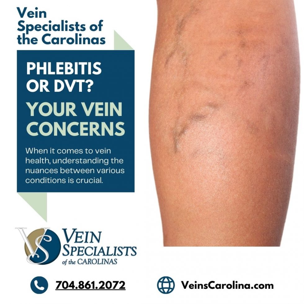 Understanding the Difference Between Phlebitis and DVT - VSC